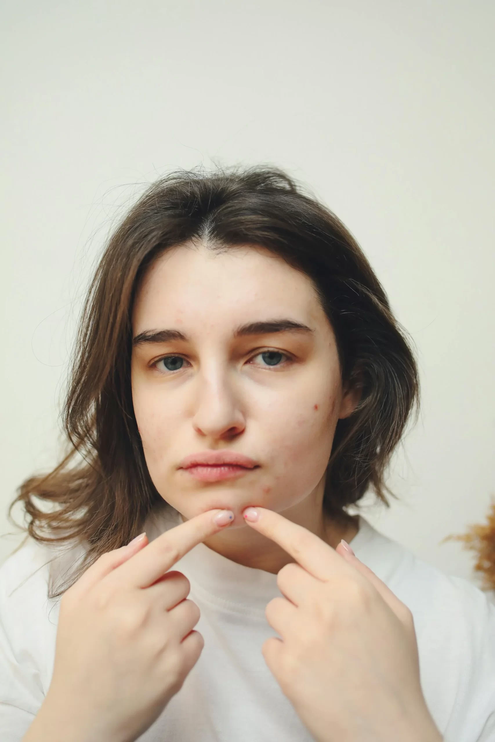 How to Get Rid of Pimples Overnight