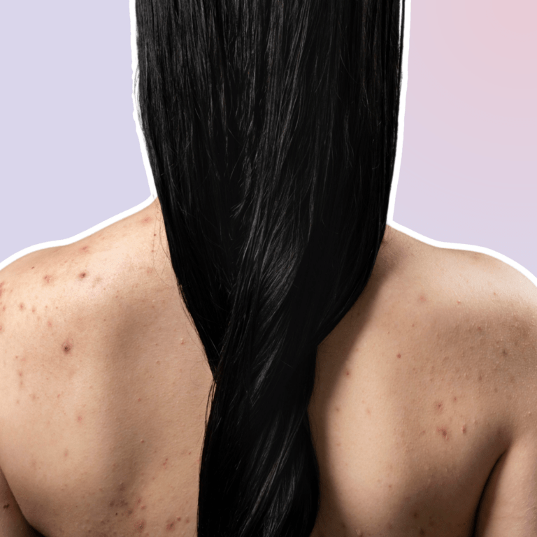 how-to-get-rid-of-back-acne