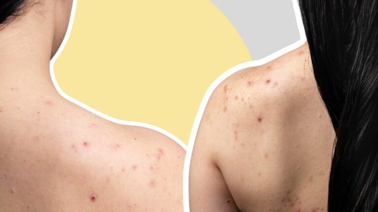 how-to-get-rid-of-back-acne